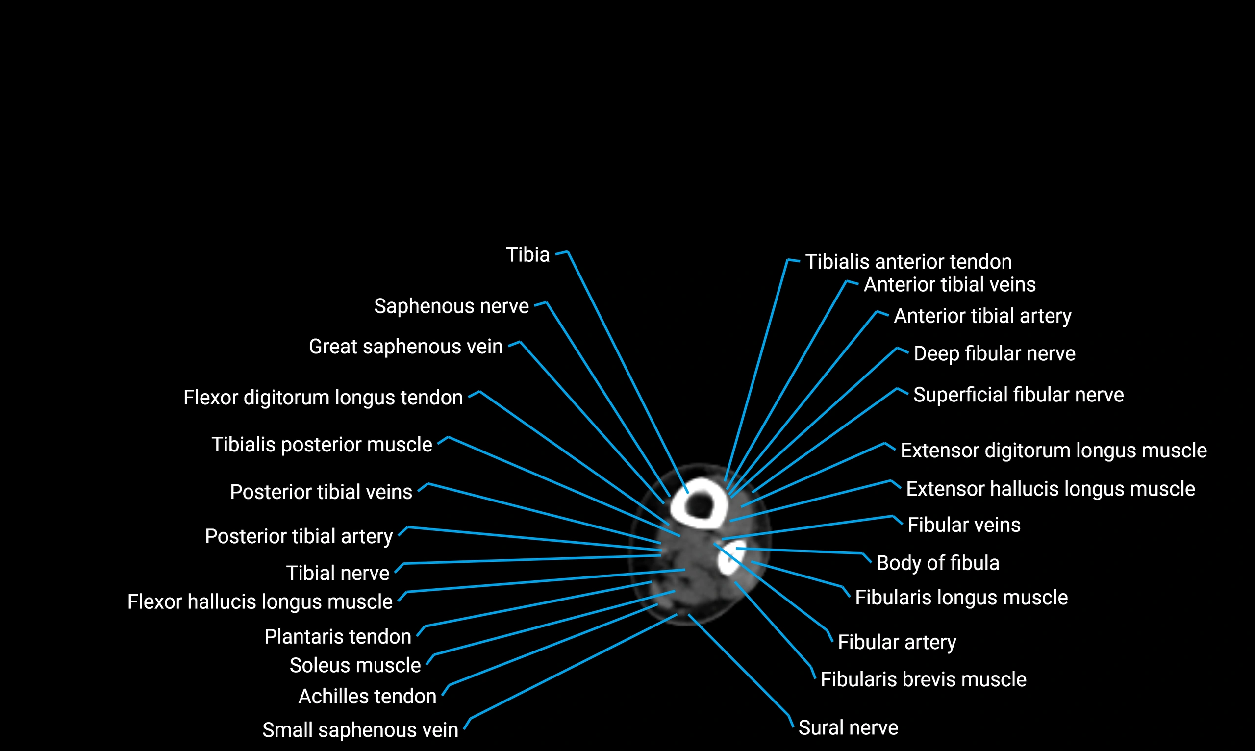 CT lower limb axial cross sectional anatomy labelled image 152 (2).webp